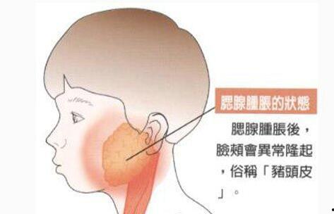 腮腺炎可以吃瓜吗,瓜类食物的适宜与禁忌